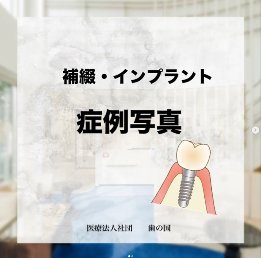 補綴・インプラント症例写真